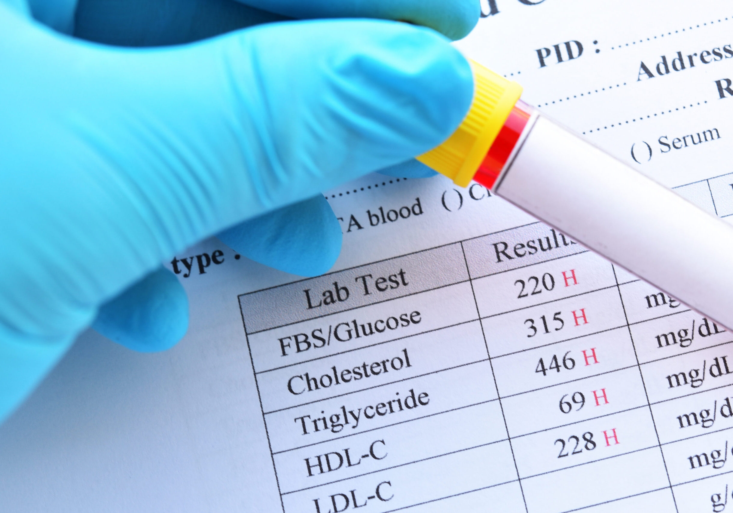 Abnormal high results of lipid profile and blood sugar test with
